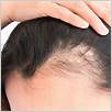 come capire se la perdita di capelli è causata dall'alopecia da trazione
