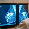 palbociclib e letrozolo nel cancro al seno avanzato